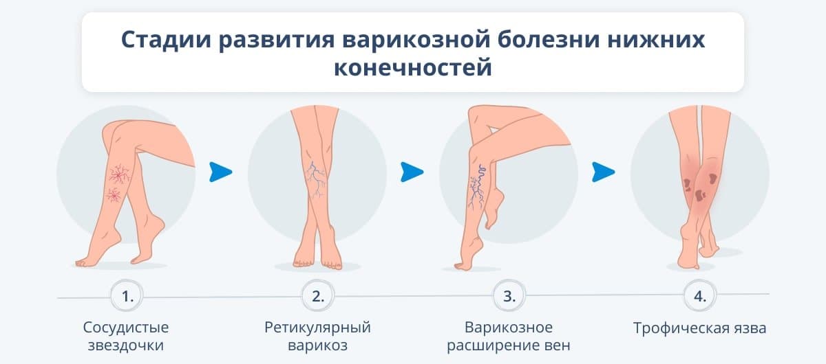 Варикоз Внутренних Вен Нижних Конечностей Симптомы Заболевания