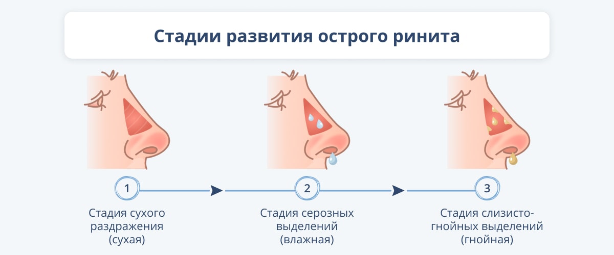 Аллергические риниты - 1