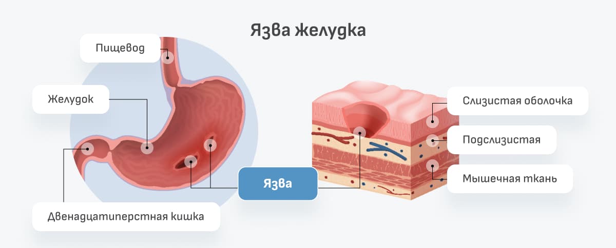 Обострение язвенной болезни желудка - почему и что делать