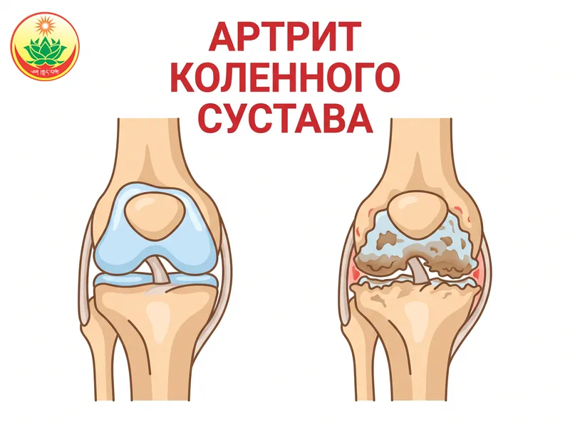 Артрит коленного сустава