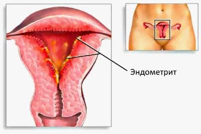 Эндометрит Эндометрит