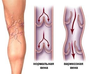 Варикоз: операция не требуется