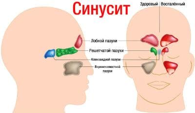 Хронический синусит Хронический синусит