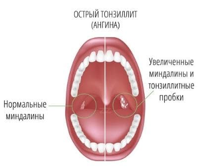 Хронический тонзиллит Хронический тонзиллит