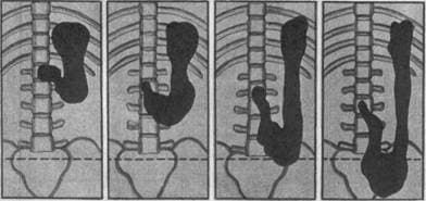 gastroptoz-2.jpg