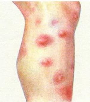 erythema-nodosum-300.jpg