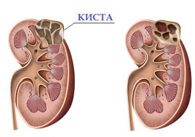 Киста почки