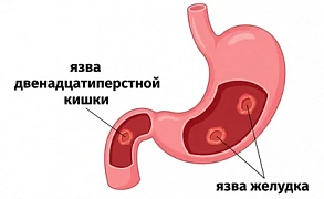 Язвенная болезнь желудка
