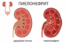 Хронический пиелонефрит